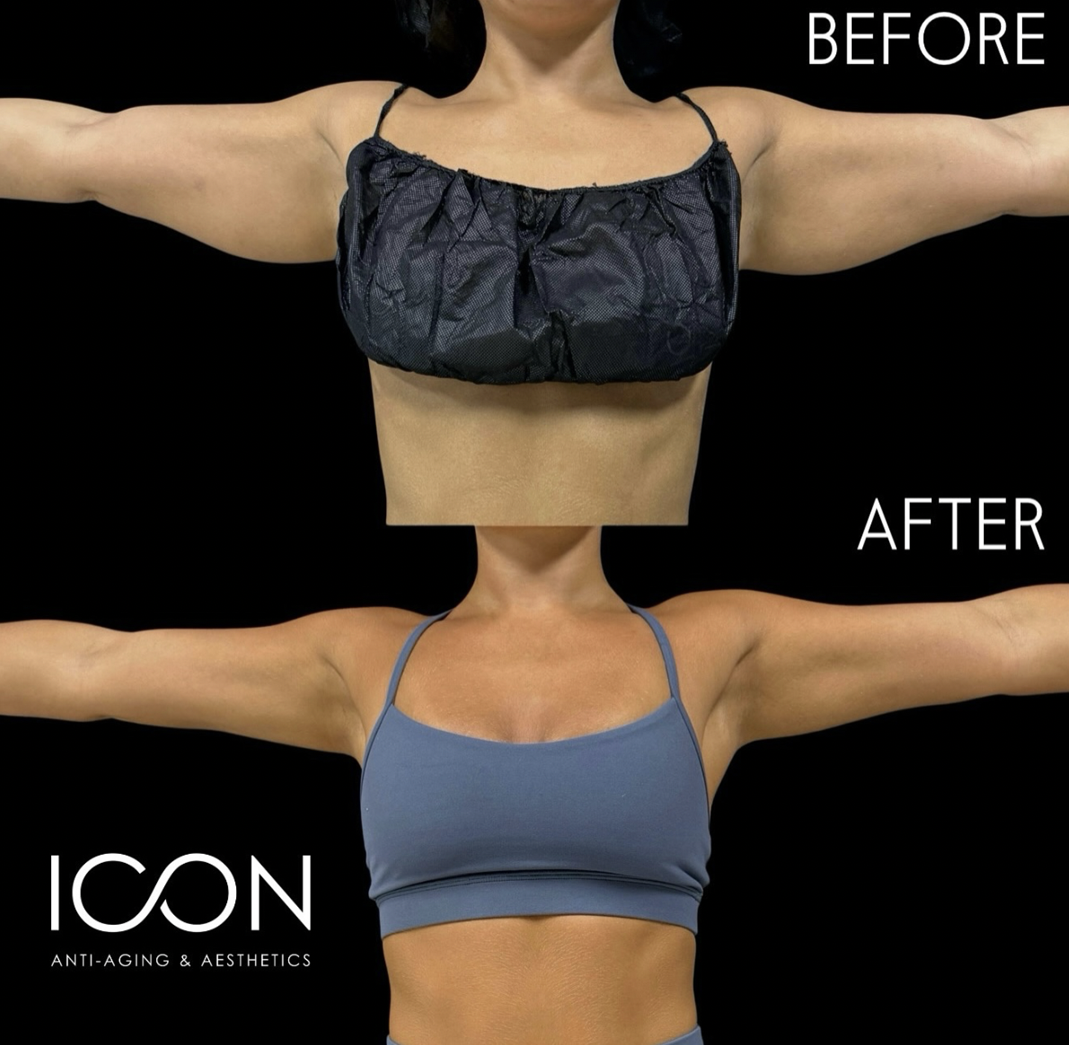 Awake Liposuction